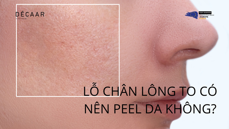 lỗ chân lông to có nên peel da